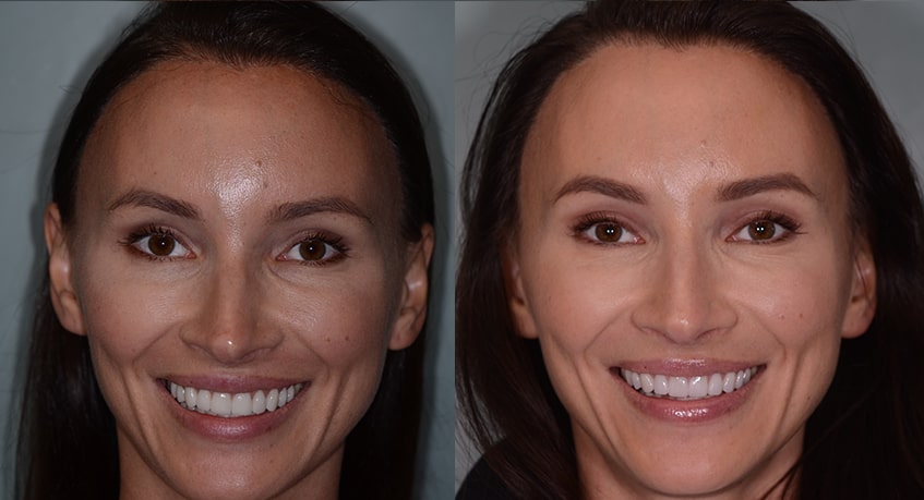 The before and after of the smile of a woman who underwent minimal cosmetic treatment