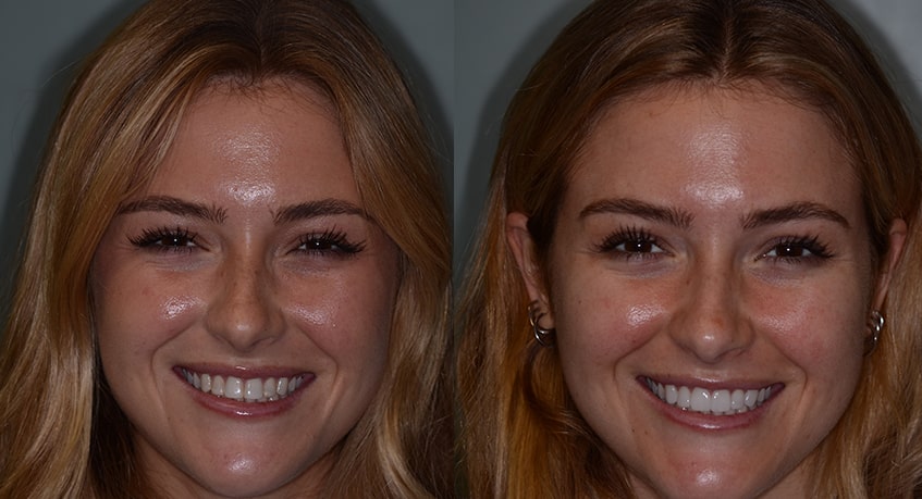 The before and after of the smile of a woman who underwent veneers treatment