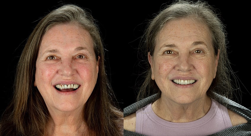 The before and after of the smile of a woman who underwent Zirconia treatment