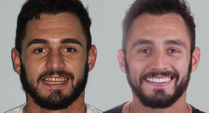 The before and after of the smile of a man who underwent a full mouth case treatment
