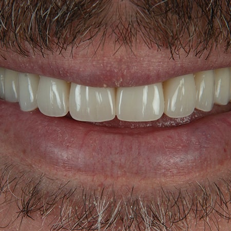 The close-up smile of a man who underwent cosmetic treatment