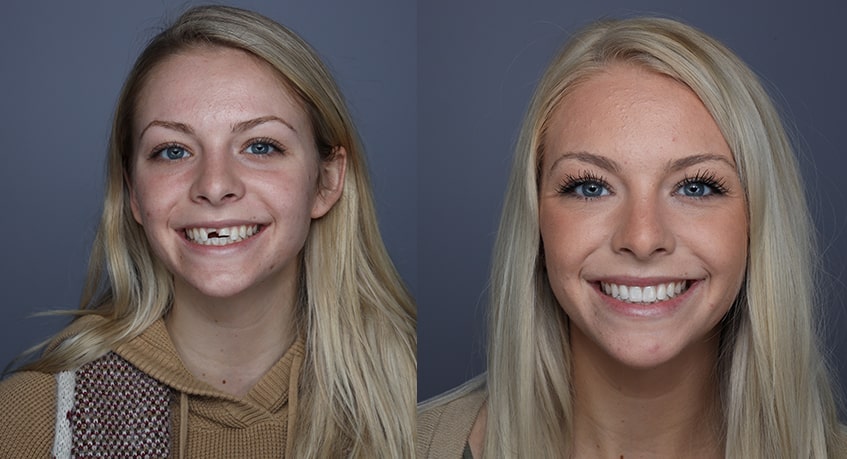 The before and after of the smile of a woman