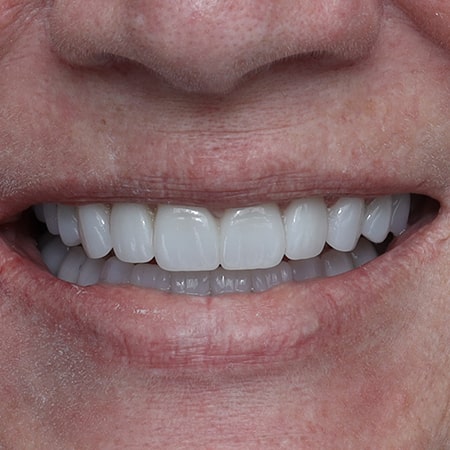 A female patient smiling after her dental reconstruction treatment